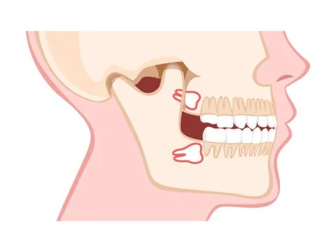Human jaw with wisdom teeth side view Illustrazione stock