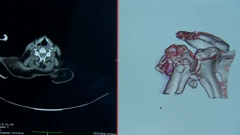 Human joints. computed tomography of human bones.  monitor screen Stock Footage 113693320