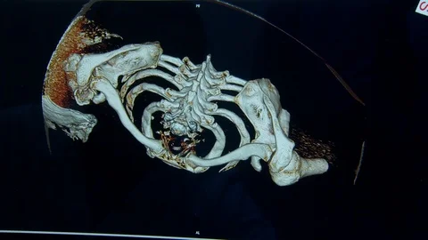 Human joints. computed tomography of human bones. ribs. monitor screen Video stock 113693712
