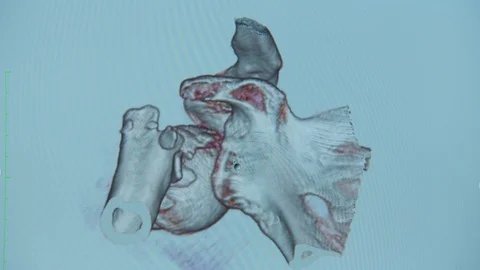 Human joints. computed tomography of human bones. Video stock 113694041