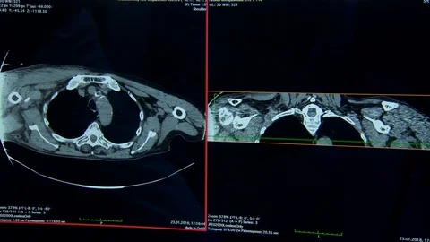 Human joints. computed tomography of human bones.  monitor screen Stockbeeldmateriaal 113694202