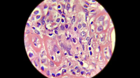 Human Kidney Pyclonephritis Section 2000x Stock Footage 39807542