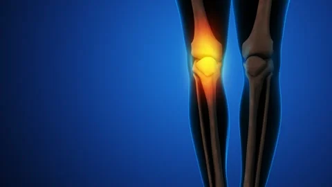 Human knee joint and bones with inflammation Vídeo Stock 275576662