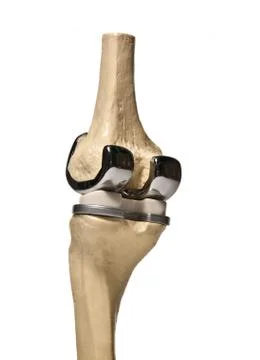 Human knee replacement Stock Photos