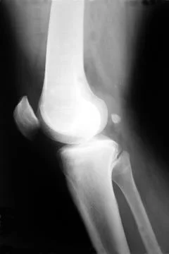 Human knee xray Stock Photos