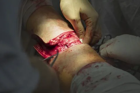 Human Leg Amputation CU Stockfoto's