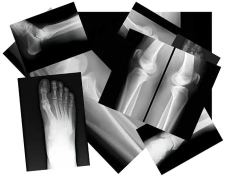 Human leg bone x-ray Stock Illustration
