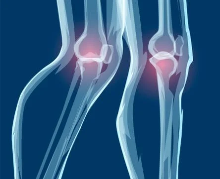 Human leg bones, x-rays. Mecial vector illustration. Stock Illustration