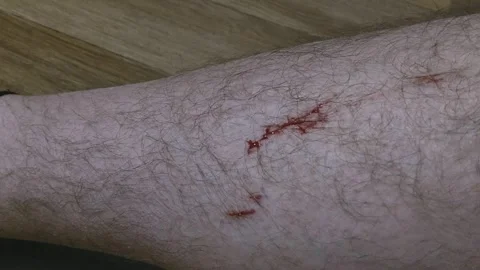 A human lower leg with several fresh superficial scratches Stock Footage 341436402