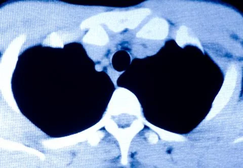 Human lumbar bone Stock Photos