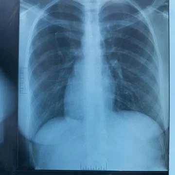 Human lung x-ray analysis, doctor examines lung disease. Pneumonia. Lung x-.. Foto stock