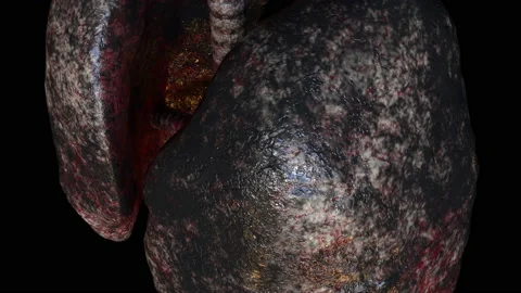Human lungs of smoker Stock Footage 170585762