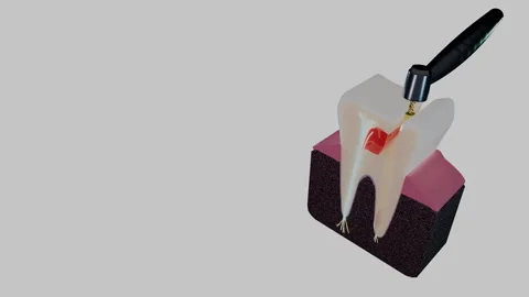 Human molar cross section showing root canal therapy and inflamed pulp, 4K Stock Footage 346120798