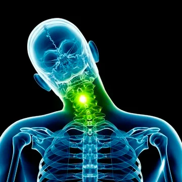 Human neck bending sideways, Illustration Stock Illustration