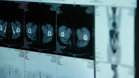 Human orage &amp; bone pet-ct scan,X-ray,Cancer metastasis. Stock Footage 22955333