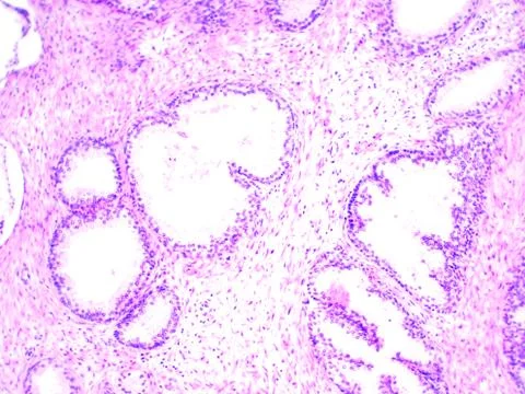 Human prostate microscopic photography Stock Photos