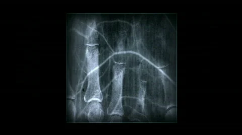 Human rib finger bone scan,tech medical X-ray,medical research,body health. Stock Footage 809351