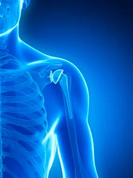 Human shoulder replacement, artwork Stock Illustration