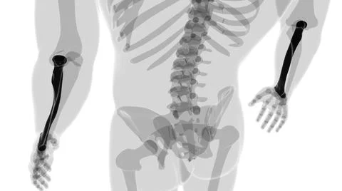 Human skeleton anatomy Radius Bone 3D Rendering 库存插图