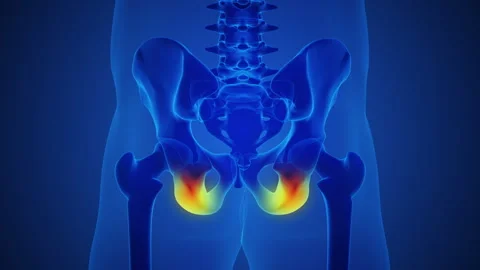 Human Skeleton and painful Hip Joint Pain Video stock 273478962