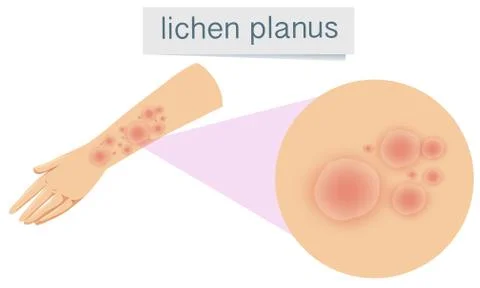 Human Skin with Lichen Planus 스톡 일러스트