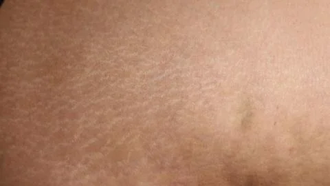 Human skin with stretch marks close -up Stock Photos