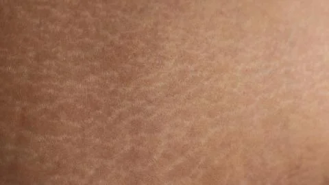 Human skin with stretch marks close -up Stock Photos