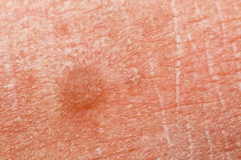 Human skin texture. Flat wart on skin micro photo. close up photo. 스톡 사진