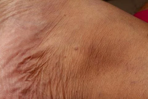Human skin texture. Flat wart on skin micro photo. close up photo. 스톡 사진