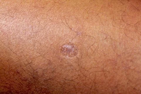 Human skin texture. Flat wart on skin micro photo. close up photo. Foto stock