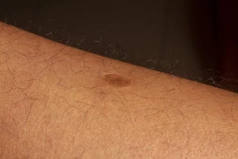 Human skin texture. Flat wart on skin micro photo. close up photo. 스톡 사진