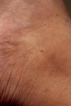 Human skin texture. Flat wart on skin micro photo. close up photo. Stock Photos