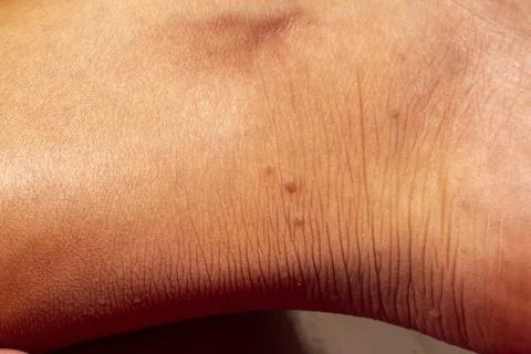 Human skin texture. Flat wart on skin micro photo. close up photo. Foto stock