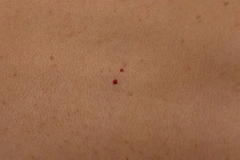 Human Skin Texture with Small Red Vascular Spots Fotos de archivo
