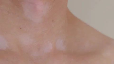 Human skin with vitiligo close-up Stock Footage 276204060