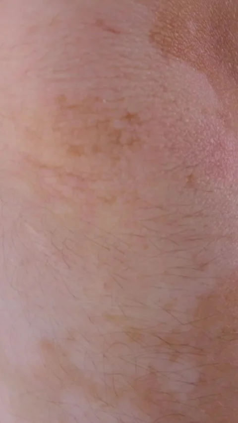 Human skin with vitiligo close-up Stock Footage 282024170