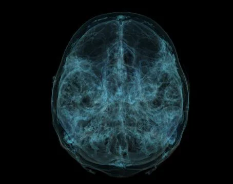 Human Skull, Brain by CT Scan. X-ray Visualization Inside Of Skull. 3D Illust Stock Illustration