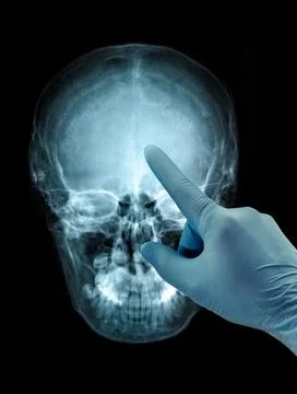Human skull X-ray front view image film hand in glove Stock Photos