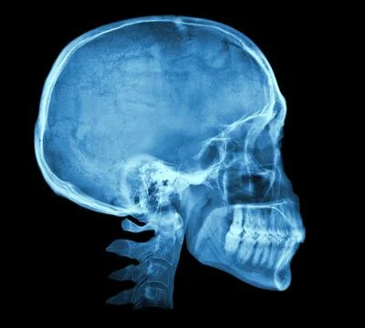Human skull X-ray image Stock Photos