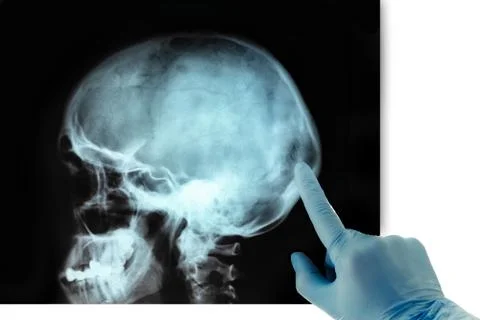 Human skull X-ray image isolated on black blue gloves Stock Photos
