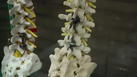 Human spine with titanium rods and screws used for spinal fusion surgery Stock Footage 334331714