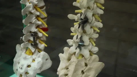 Human spine with titanium rods and screws used for spinal fusion surgery Stock Footage 334331716