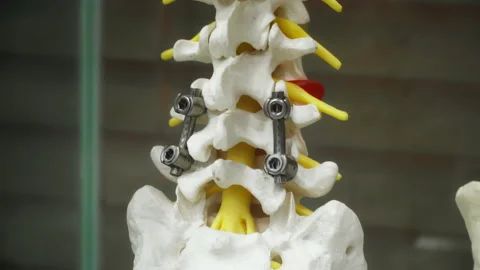 Human spine with titanium rods and screws used for spinal fusion surgery Stock Footage 334332975