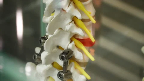 Human spine with titanium rods and screws used for spinal fusion surgery Stock Footage 334333070