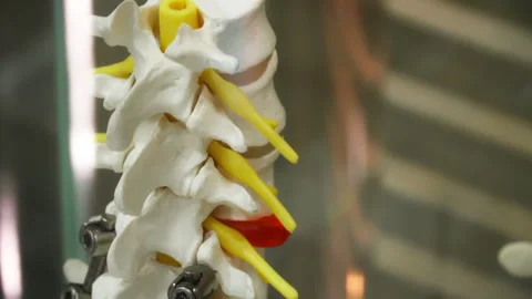 Human spine with titanium rods and screws used for spinal fusion surgery Stock Footage 334333122