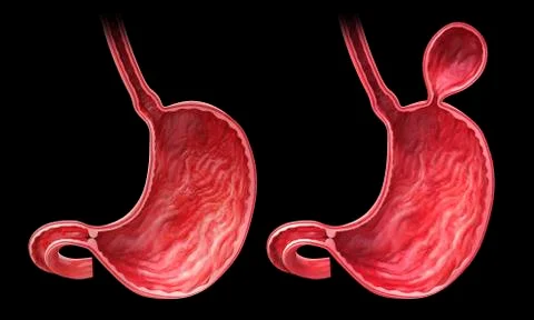 Human stomach with hernia, artwork Stock Illustration