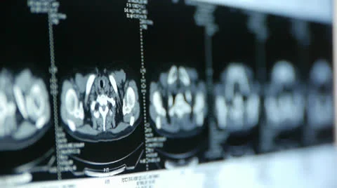 Human subclavian pet-ct scan,lymph nodes X-ray,Cancer metastasis. Stock Footage 22944180
