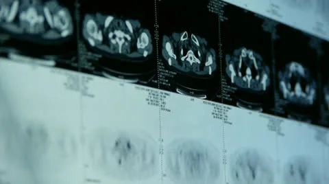 Human subclavian pet-ct scan,lymph nodes X-ray,Cancer metastasis. Vidéo 22945160