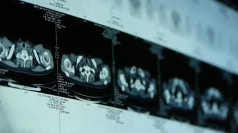 Human subclavian pet-ct scan,lymph nodes X-ray,Cancer metastasis. Stock-Footage 22945389