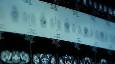 Human subclavian pet-ct scan,lymph nodes X-ray,Cancer metastasis. 스톡 동영상 22946470